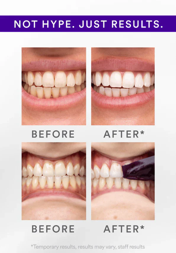 Whitening Strips-30-Minute Whitening