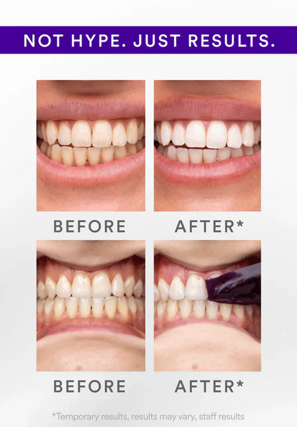 Whitening Strips-30-Minute Whitening